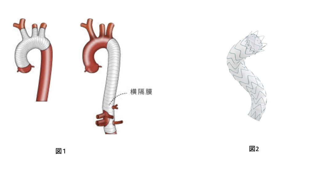 人工血管及びステントグラフトのイメージ
