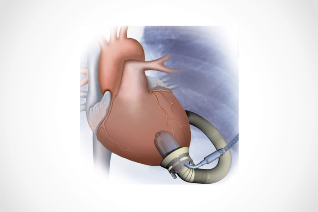 LVAD取り付けのイメージ図
