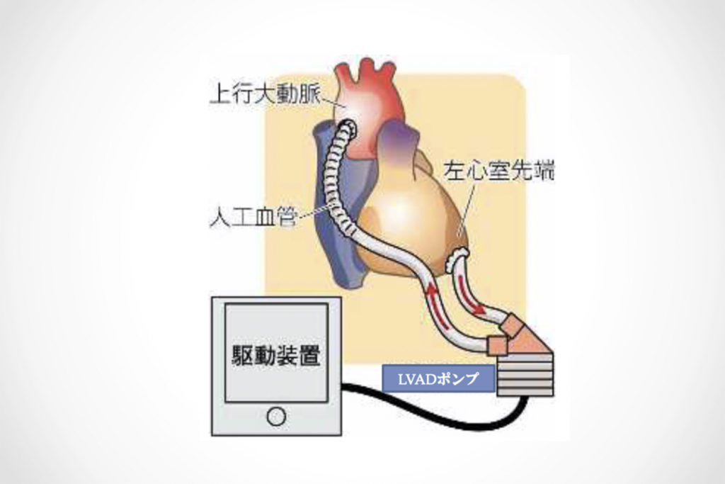 LVAD取り付けのイメージ図