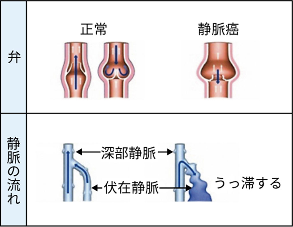 静脈瘤の原因について