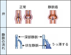 下肢静脈瘤の原因
